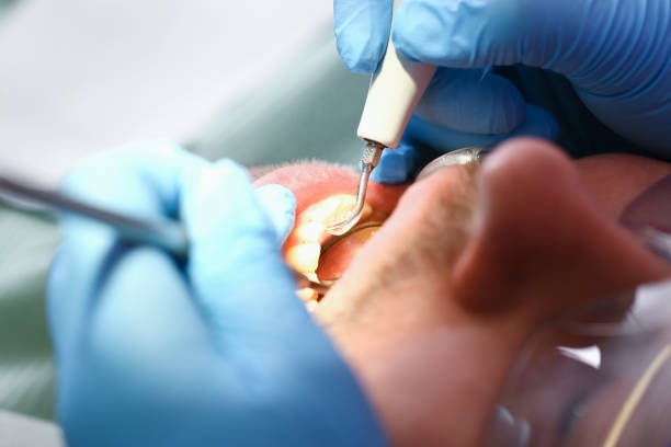 Best Emergency Treatment for Dental Infections or Abscesses in Warren, MN